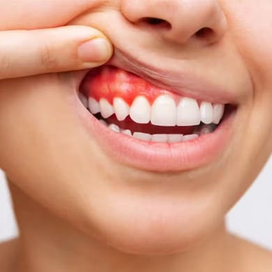 Gingivitis