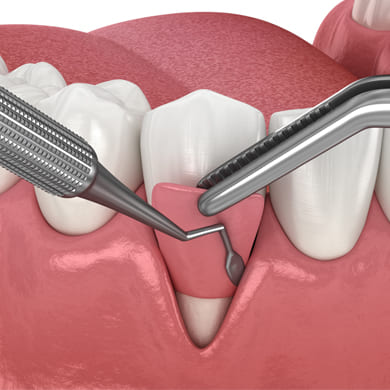Gum Surgeries