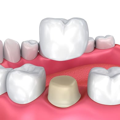 tooth-crown