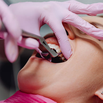 tooth-extraction
